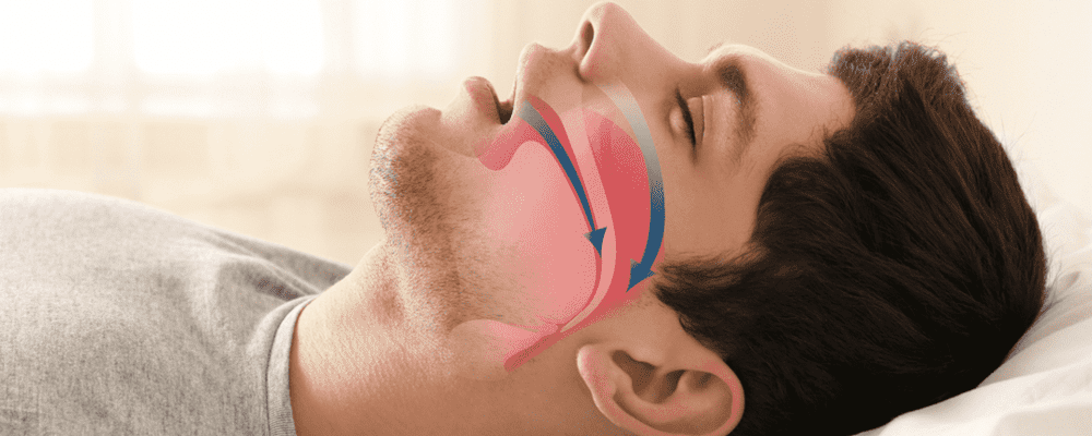 Sleep Apnea treatment in Greater Noida