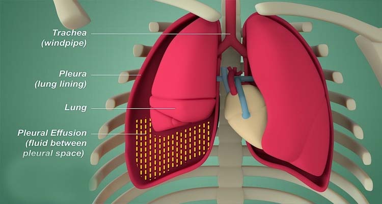 Pleural Diseases treatment in Greater Noida